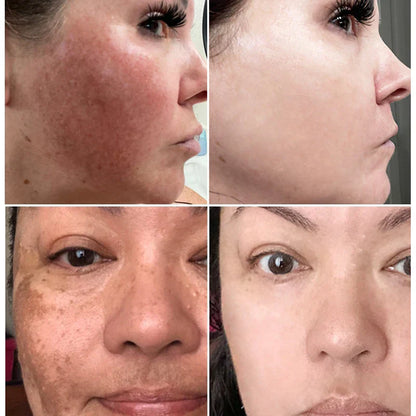 NNEOBA Whitening Freckles Cream - Korean Skincare